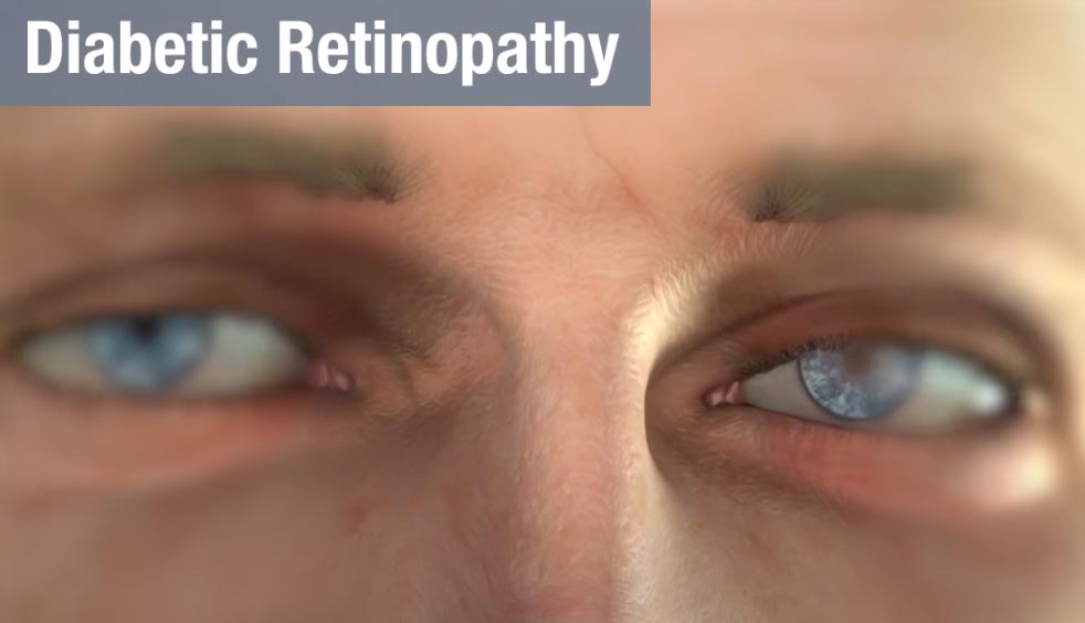 Diabetic Retinopathy