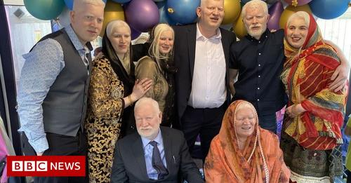 Albinism: Coventry family embraces Guinness World Record